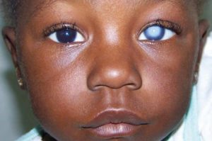 Cécité enfant onchocercose ivermectine Coronavirus acheter immobilier en Espagne